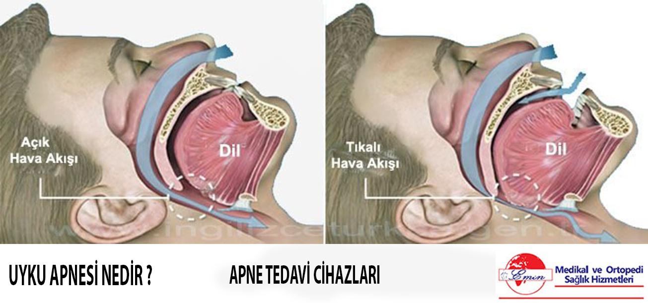 uyku apnesi